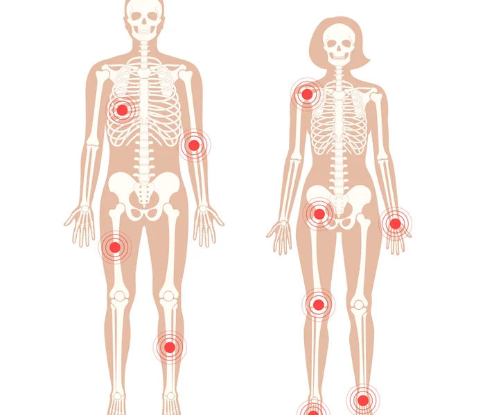 Fibromialgia que doença é essa?